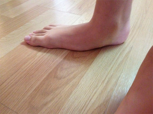 Βλαισοπλατυποδία