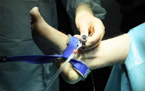 Συνδεσμικές κακώσεις ποδοκνημικής άρθρωσης